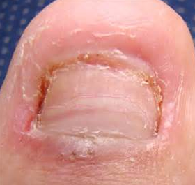 灰指甲的发病原因是什么