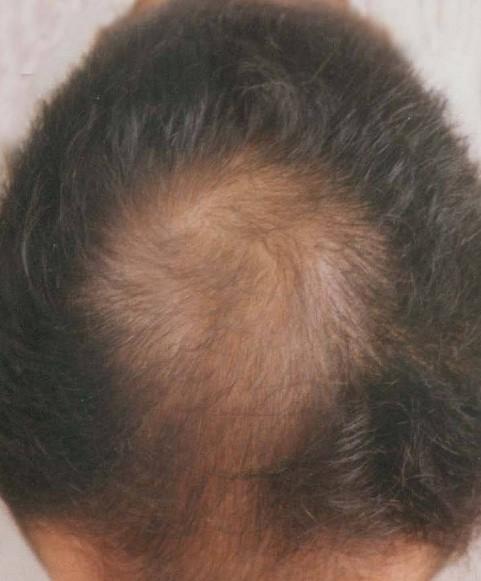郑州脱发的日常方法预防有哪些